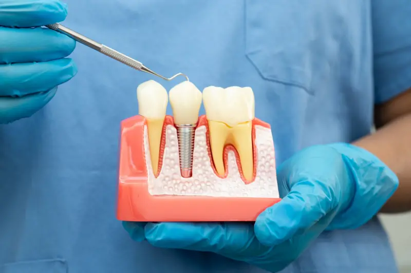 It is an alternative for those who have lost teeth.